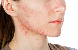 Struggle Against Acne skin problem