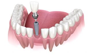dental implantology courses toronto Dr. Berzin Dental Implants