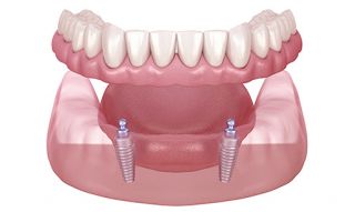 dental implantology courses toronto Dr. Berzin Dental Implants